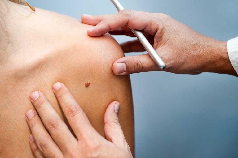 A close-up of a hand applying cream to a red, irritated patch of skin on a person's foot.